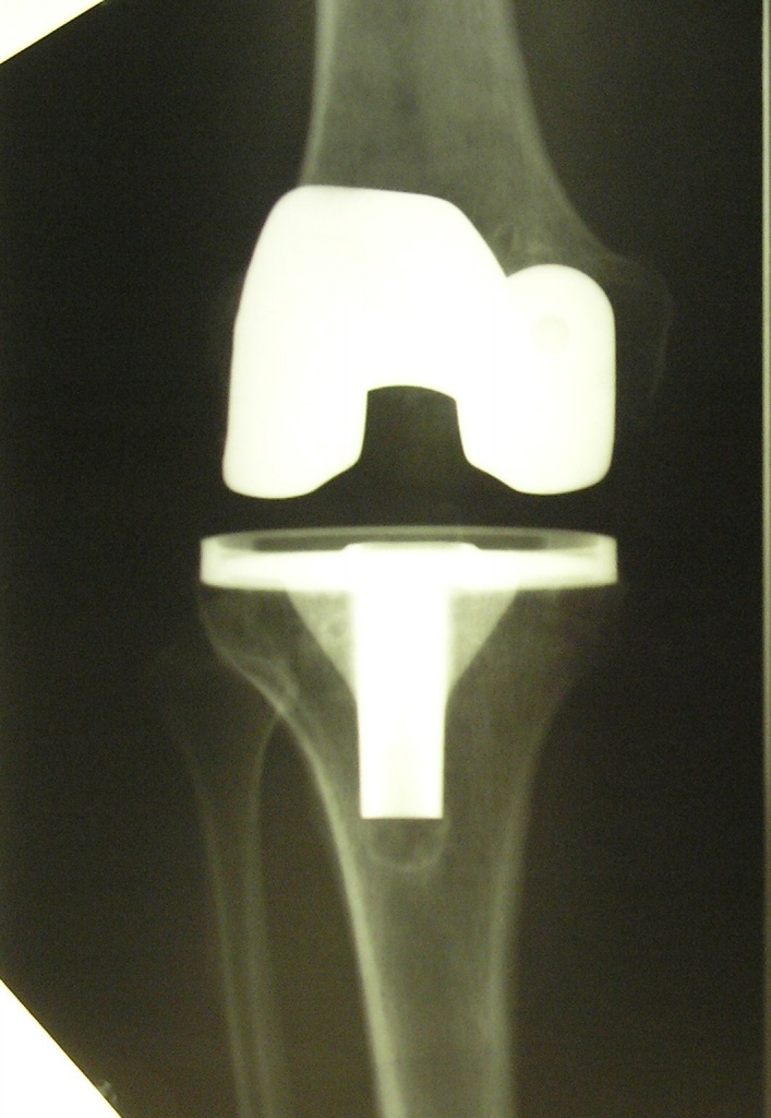 Не правильное положение коленного протеза 1