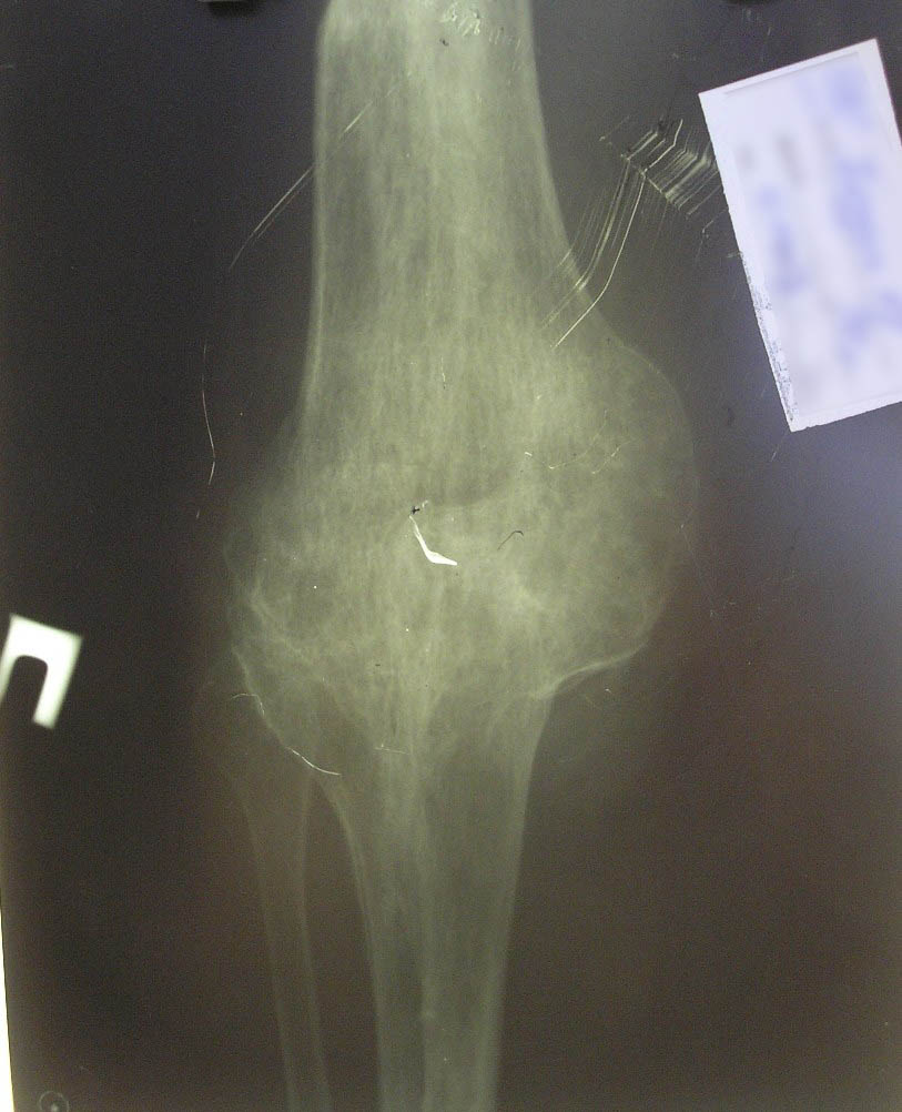 Сросшийся коленный сустав – результат остеоартроза