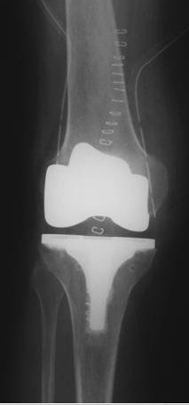 Правильное положение коленного протеза 1