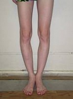 Коррекция формы ног и увеличение роста